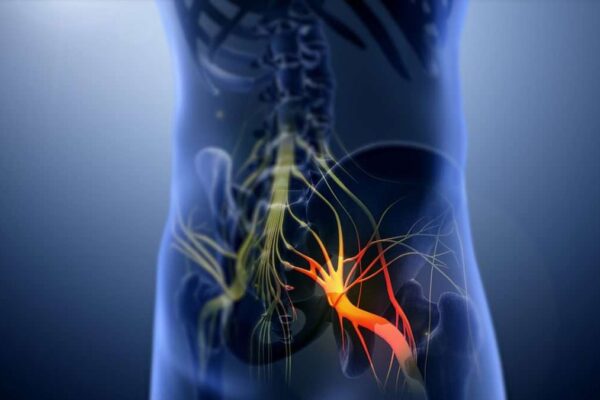 It’s probably not sciatica (and why that’s important)