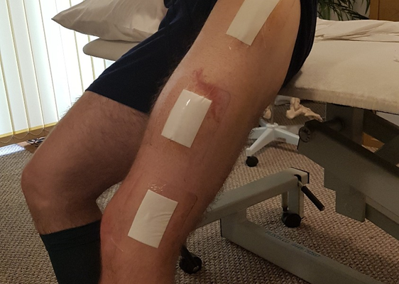 Recovery after surgery